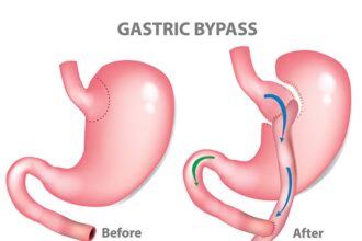 Gastric Bypass Surgery