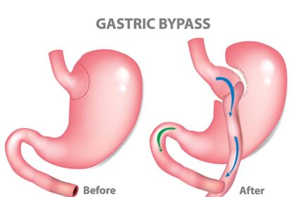 Gastric Bypass Surgery