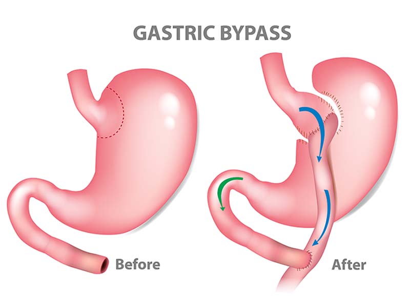 Gastric Bypass Surgery