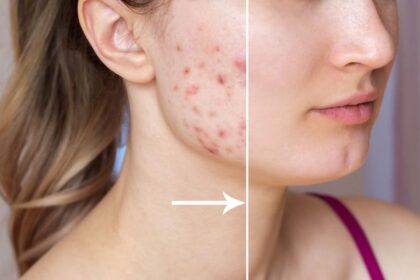 Treating Acne and Scarring