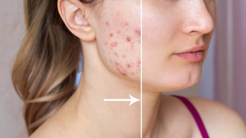 Treating Acne and Scarring