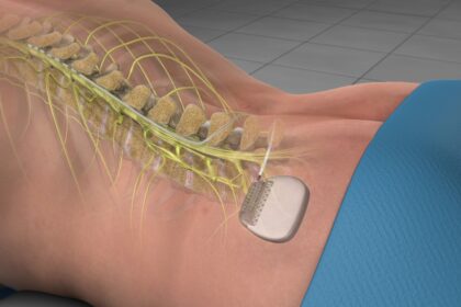 Spinal Cord Stimulation