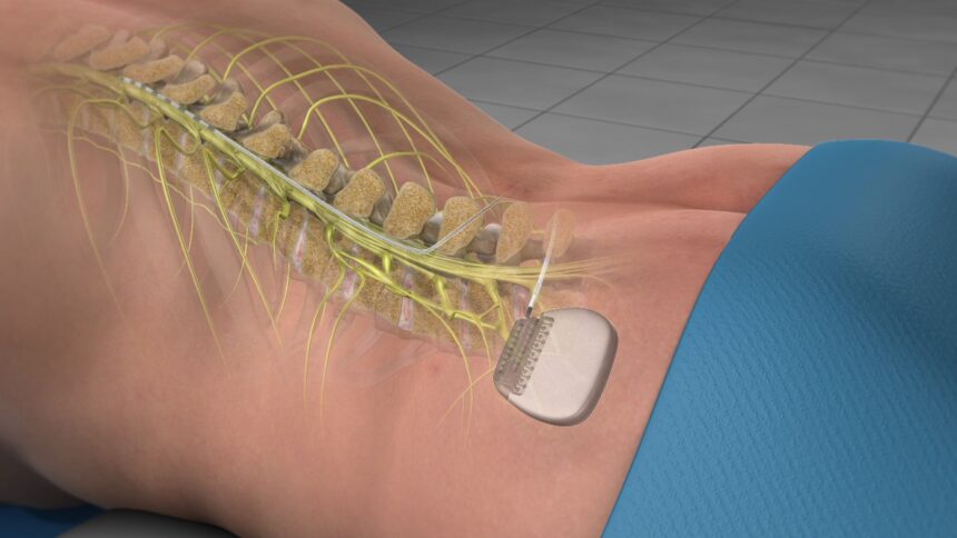 Spinal Cord Stimulation