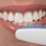 Caring for Teeth After Getting Veneers