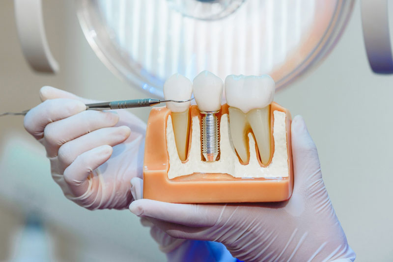 Innovations in Dental Implant