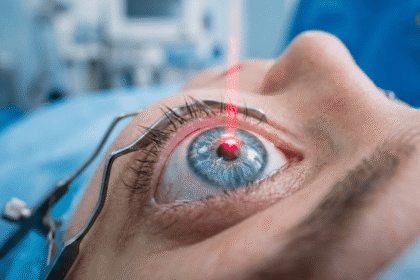 Laser Eye Surgeries