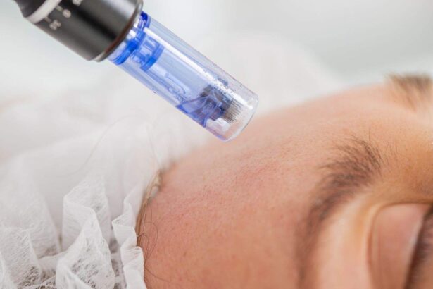 Optimal Microneedling Aftercare