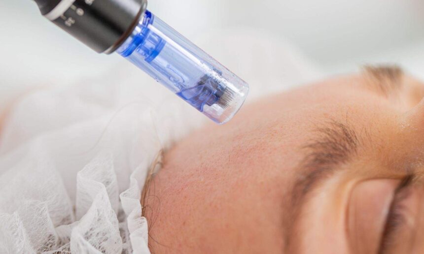 Optimal Microneedling Aftercare
